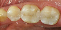 after dental treatment image