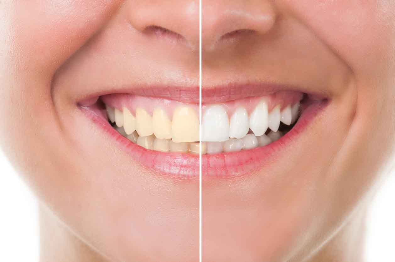 close up of before and after teeth whitening