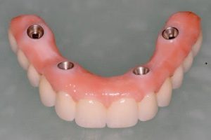 fixed dental prosthesis