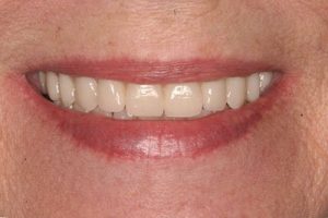 fixed dental implant teeth