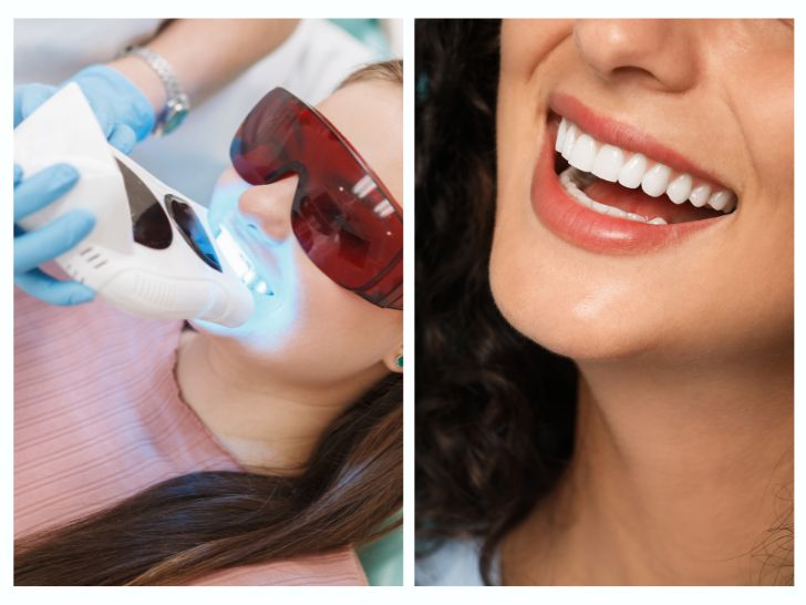 Teeth whitening or veneers for your teeth