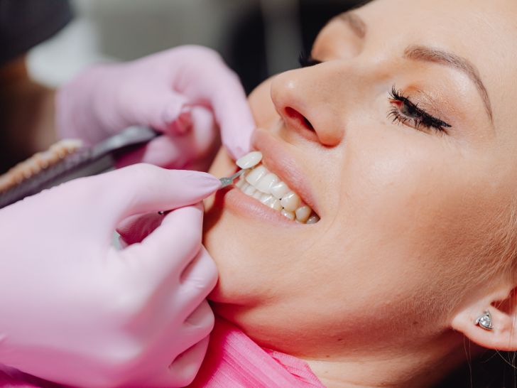 Full sets of veneers